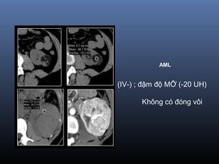 (IV-) ; đậm độ MỠ (-20 UH)
Không có đóng vôi
AML
 