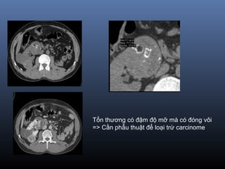 Tổn thương có đậm độ mỡ mà có đóng vôi
=> Cần phẫu thuật để loại trừ carcinome
 