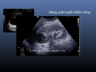 Nang xuất huyết nhiễm trùng
 