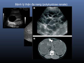 Bệnh lý thận đa nang (polykystose renale)
 