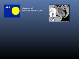 Không có vách
Bắt thuốc kém < 10UH
 