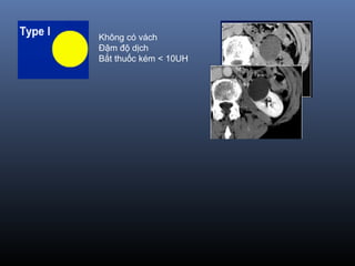 Không có vách
Đậm độ dịch
Bắt thuốc kém < 10UH
 