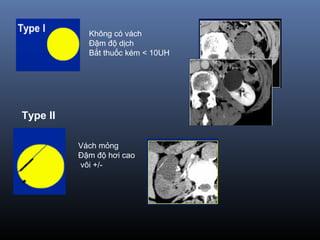 Không có vách
Đậm độ dịch
Bắt thuốc kém < 10UH
Type II
Vách mỏng
Đậm độ hơi cao
vôi +/-
 