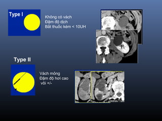 Không có vách
Đậm độ dịch
Bắt thuốc kém < 10UH
Type II
Vách mỏng
Đậm độ hơi cao
vôi +/-
 