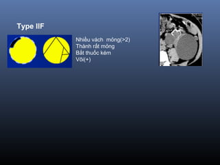 Type IIF
Nhiều vách mỏng(>2)
Thành rất mỏng
Bắt thuốc kém
Vôi(+)
 