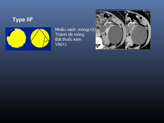 Type IIF
Nhiều vách mỏng(>2)
Thành rất mỏng
Bắt thuốc kém
Vôi(+)
 