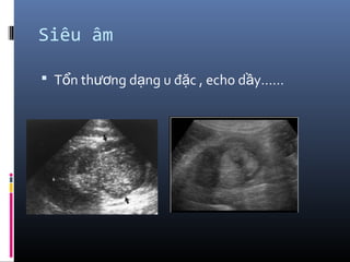 Siêu âm
 T n th ng d ng u đ c , echo d y……ổ ươ ạ ặ ầ
 