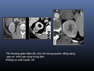 Tổn thương giảm đậm độ, chủ mô chung quanh: đồng dạng
sẹo xơ hình sao vùng trung tâm
Không có xuất huyết, vôi
 