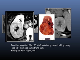 Tổn thương giảm đậm độ, chủ mô chung quanh: đồng dạng
sẹo xơ hình sao vùng trung tâm
Không có xuất huyết, vôi
 