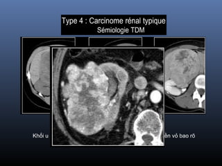 Khối u lớn, không đồng dạng, hoại tử trung tâm, bờ viền vỏ bao rõ
 
