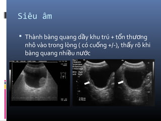 Siêu âm
 Thành bàng quang d y khu trú + t n th ngầ ổ ươ
nhô vào trong lòng ( có cu ng +/-), th y rõ khiố ấ
bàng quang nhi u n cề ướ
 