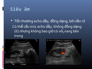 Siêu âm
 T n th ng echo d y, đ ng d ng, b vi n rõổ ươ ầ ồ ạ ờ ề
Có th c u trúc echo d y, không đ ng d ngể ấ ầ ồ ạ
(ít) nh ng không bao gi có vôi,nang bênư ờ
trong
 