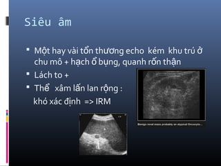 Siêu âm
 M t hay vài t n th ng echo kém khu trúộ ổ ươ ở
chu mô + h ch b ng, quanh r n th nạ ổ ụ ố ậ
 Lách to +
 Th xâm l n lan r ng :ể ấ ộ
khó xác đ nh => IRMị
 