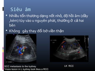 Siêu âm
 Nhi u t n th ng d ng n t nh , đ h i âm (d yề ổ ươ ạ ố ỏ ộ ồ ầ
,kém) tùy vào u nguyên phát, th ng c haiườ ở ả
bên
 Không gây thay đ i b vi n th nổ ờ ề ậ
SCC metastasis to the kydney
“mass lesion in L kydney look likes a RCC
LK RCC
 