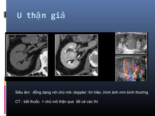 U th n giậ ả
Siêu âm: đồng dạng với chủ mô- doppler: tín hiệu ,hình ành mm bình thường
CT : bắt thuốc = chủ mô thận qua tất cả các thì
 