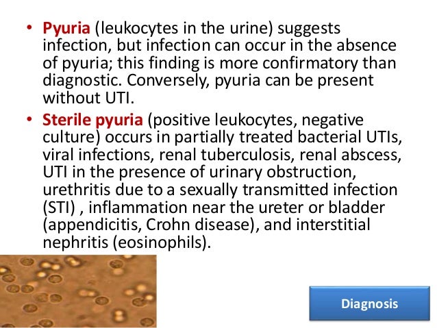 • Nitrites and leukocyte esterase usually are positive in infected urine. • Microscopic hematuria is common in acute cysti...