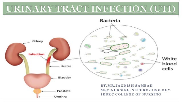 Urinary tract infection (UTI) diagram for urinalysis 