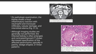  On pathologic examination, the
kidney shows a focal
inflammatory reaction with
neutrophil and monocyte
infiltrates, tubular damage, and
interstitial edema (Fig. 51.3).
 Although imaging studies are
generally not performed, the
infected kidney is often enlarged,
and contrastenhanced CT shows
decreased opacification of the
affected parenchyma, typically in
patchy, wedge-shaped, or linear
patterns
 