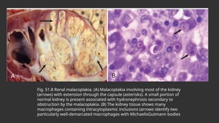 Fig. 51.8 Renal malacoplakia. (A) Malacoplakia involving most of the kidney
(arrows) with extension through the capsule (asterisks). A small portion of
normal kidney is present associated with hydronephrosis secondary to
obstruction by the malacoplakia. (B) The kidney tissue shows many
macrophages containing intracytoplasmic inclusions (arrows identify two
particularly well-demarcated macrophages with MichaelisGutmann bodies
 