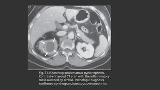 Fig. 51.9 Xanthogranulomatous pyelonephritis.
Contrast-enhanced CT scan with the inflammatory
mass outlined by arrows. Pathologic diagnosis
confirmed xanthogranulomatous pyelonephritis
 