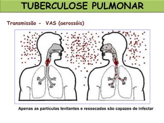 TUBERCULOSE PULMONAR
Transmissão - VAS (aerossóis)
Apenas as partículas levitantes e ressecadas são capazes de infectar
 