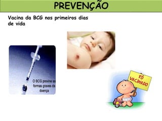PREVENÇÃO
Vacina da BCG nos primeiros dias
de vida
 