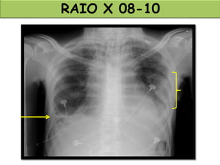 RAIO X 08-10
 