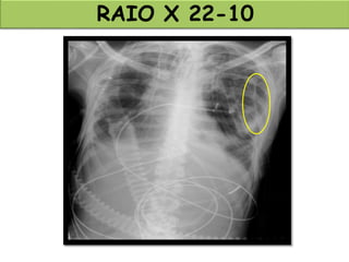 RAIO X 22-10
 