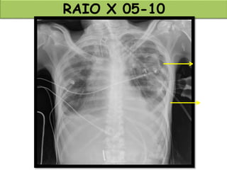 RAIO X 05-10
 