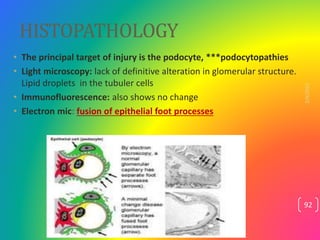 HISTOPATHOLOGY
• The principal target of injury is the podocyte, ***podocytopathies
• Light microscopy: lack of definitive...
