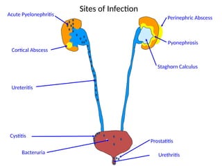 Acute Pyelonephritis
Pyonephrosis
Perinephric Abscess
Staghorn Calculus
Ureteritis
Prostatitis
Urethritis
Bacteruria
Cystitis
Cortical Abscess
Sites of Infection
 