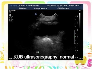 KUB ultrasonography: normal
 