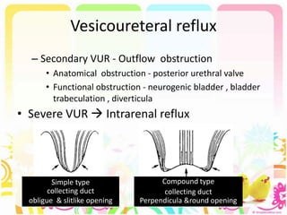 Vesicoureteral reflux
– Secondary VUR - Outflow obstruction
• Anatomical obstruction - posterior urethral valve
• Functional obstruction - neurogenic bladder , bladder
trabeculation , diverticula
• Severe VUR  Intrarenal reflux
Simple type
collecting duct
obligue & slitlike opening
Compound type
collecting duct
Perpendicula &round opening
 