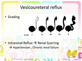 Vesicoureteral reflux
• Grading
• Intrarenal Reflux  Renal Scarring
 Hypertension , Chronic renal failure
 