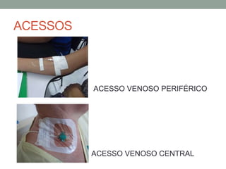 ACESSOS
ACESSO VENOSO PERIFÉRICO
ACESSO VENOSO CENTRAL
 