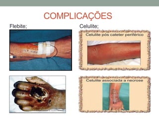 COMPLICAÇÕES
Flebite; Celulite;
 