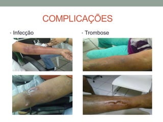 COMPLICAÇÕES
• Infecção • Trombose
 