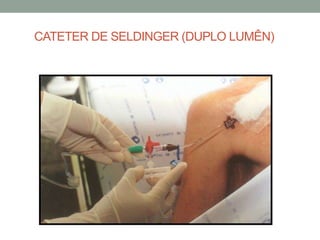 CATETER DE SELDINGER (DUPLO LUMÊN)
 