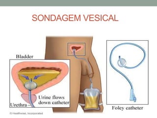 SONDAGEM VESICAL
 