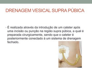 DRENAGEM VESICAL SUPRA PÚBICA
• É realizada através da introdução de um cateter após
uma incisão ou punção na região supra púbica, a qual é
preparada cirurgicamente, sendo que o cateter é
posteriormente conectado à um sistema de drenagem
fechado.
 