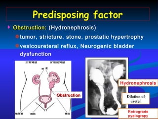 Obstruction:  ( Hydronephrosis) tumor, stricture, stone, prostatic hypertrophy vesicoureteral reflux, Neurogenic bladder dysfunction Predisposing factor Hydronephrosis Dilation of ureter Obstruction Retrograde pyelograpy 