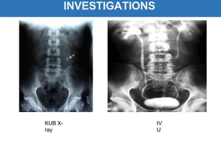 INVESTIGATIONS
KUB X-
ray
IV
U
 
