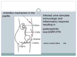Antireflux mechanism in the
papilla
vesico uretral reflux risk
Infected urine stimulate
immunologic and
inflammatory response
resulting in
pyelonephritic
scar,ESRF,HTN
 