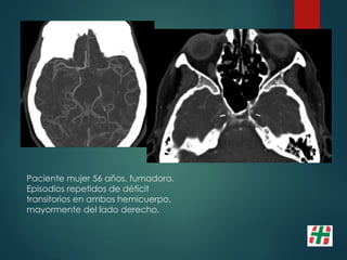Paciente mujer 56 años, fumadora.
Episodios repetidos de déficit
transitorios en ambos hemicuerpo,
mayormente del lado derecho.
 