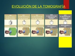 EVOLUCIÓN DE LA TOMOGRAFÍA
2004
TC MULTISLICE (40)
0.33 seg. de
rotación
120 imágenes x
seg.
2005
TC MULTISLICE (64)
0.33 seg. de
rotación
180 imágenes x
seg.
 