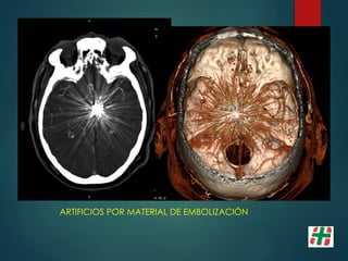 ARTIFICIOS POR MATERIAL DE EMBOLIZACIÓN
 