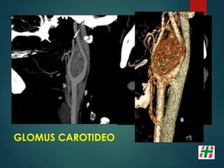 GLOMUS CAROTIDEO
 