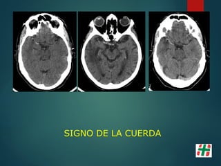 SIGNO DE LA CUERDA
 