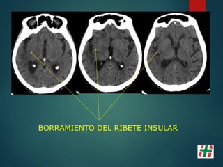 BORRAMIENTO DEL RIBETE INSULAR
 