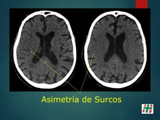 Asimetría de Surcos
 